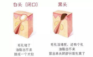 辨別黑頭與閉口，黑頭儀的正確使用與誤區
